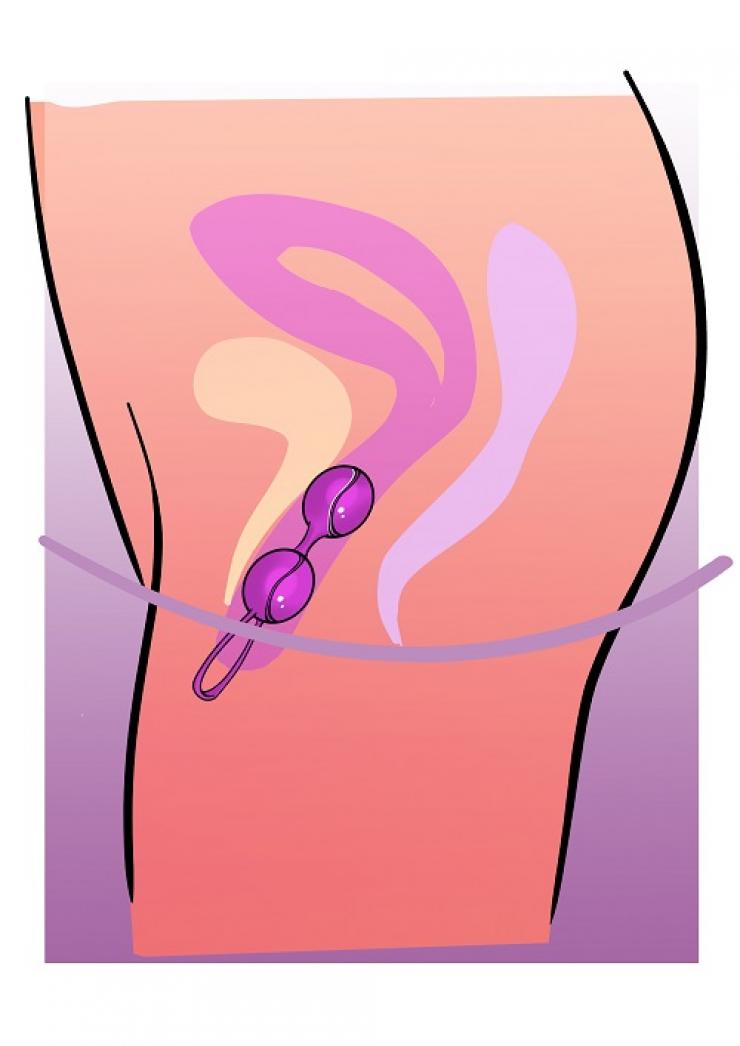 plaatsing van kegelballetjes in vagina